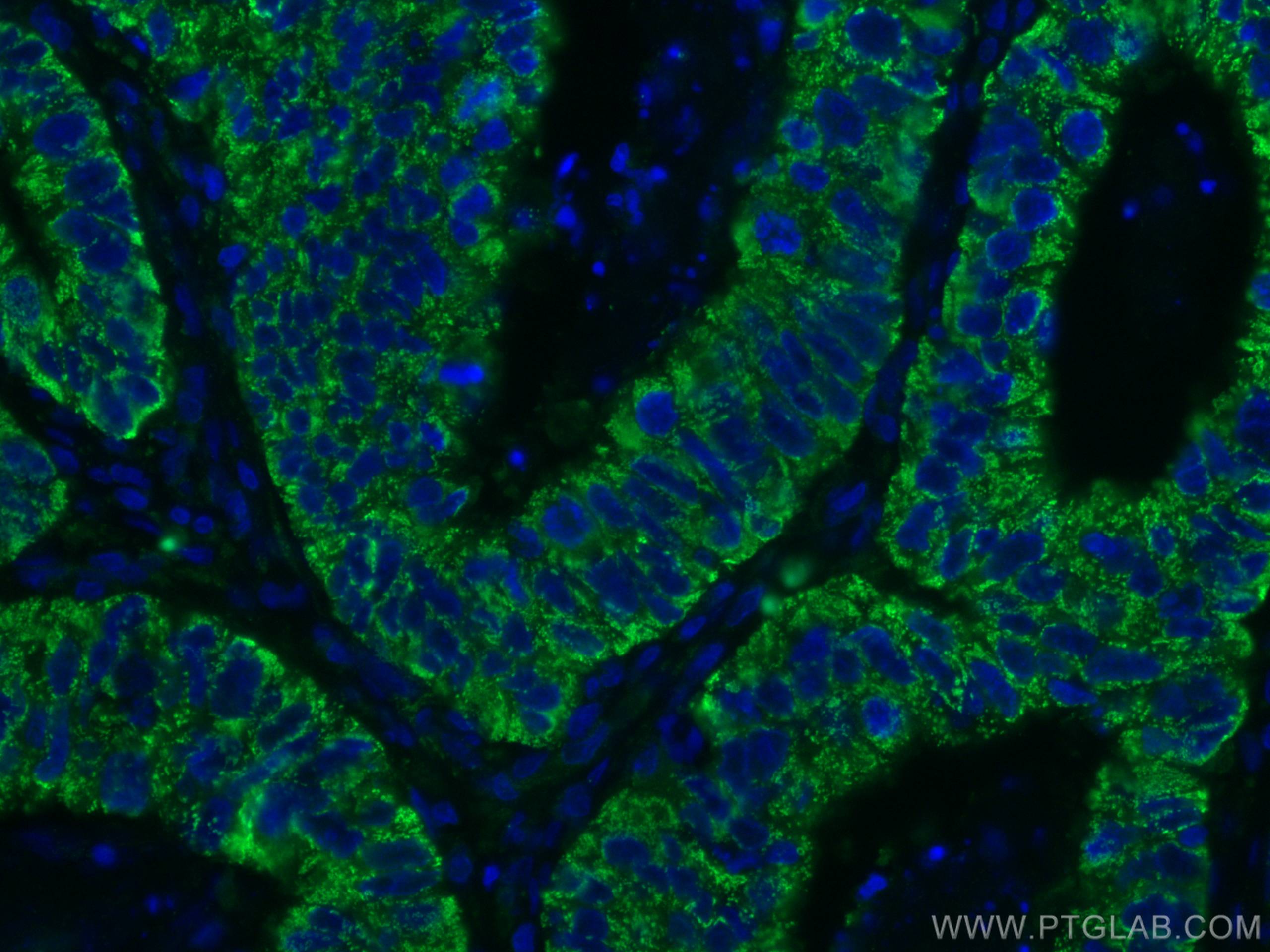 Immunofluorescence (IF) / fluorescent staining of human colon cancer tissue using CNOT4 Monoclonal antibody (67798-1-Ig)