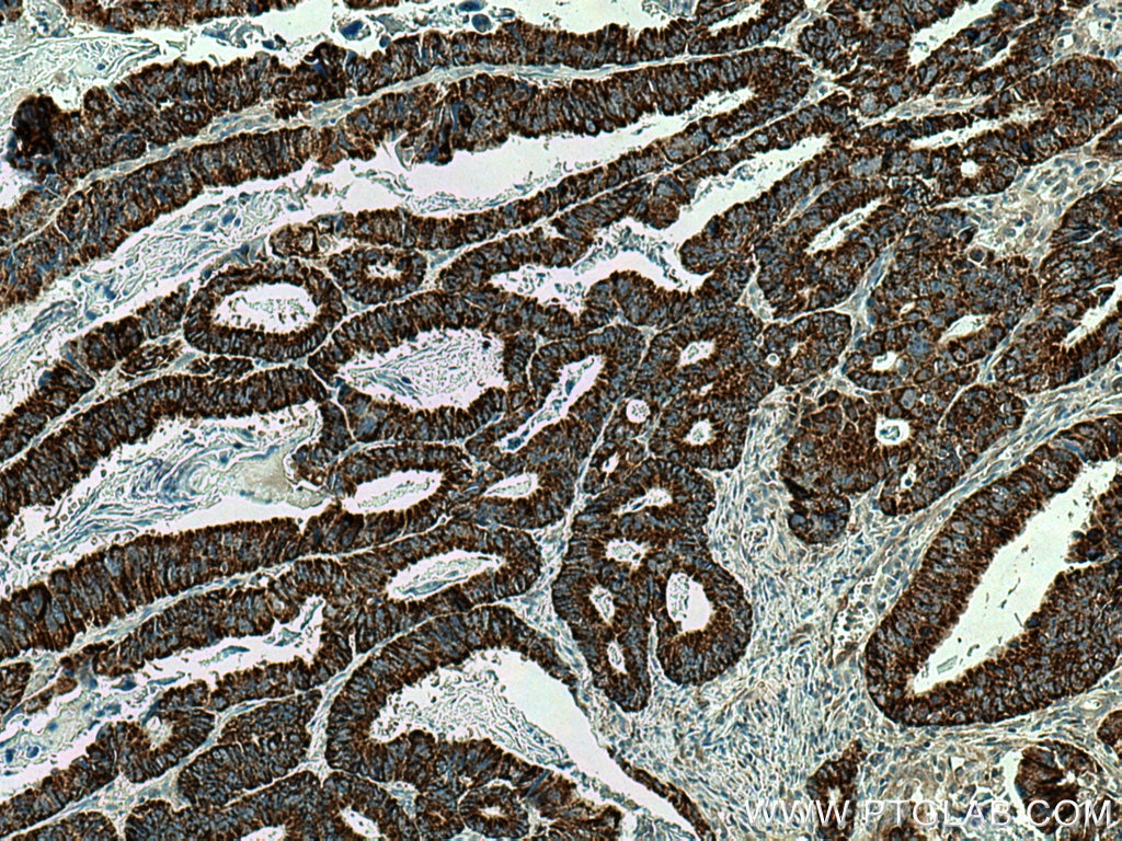 Immunohistochemistry (IHC) staining of human colon cancer tissue using CNOT4 Monoclonal antibody (67798-1-Ig)