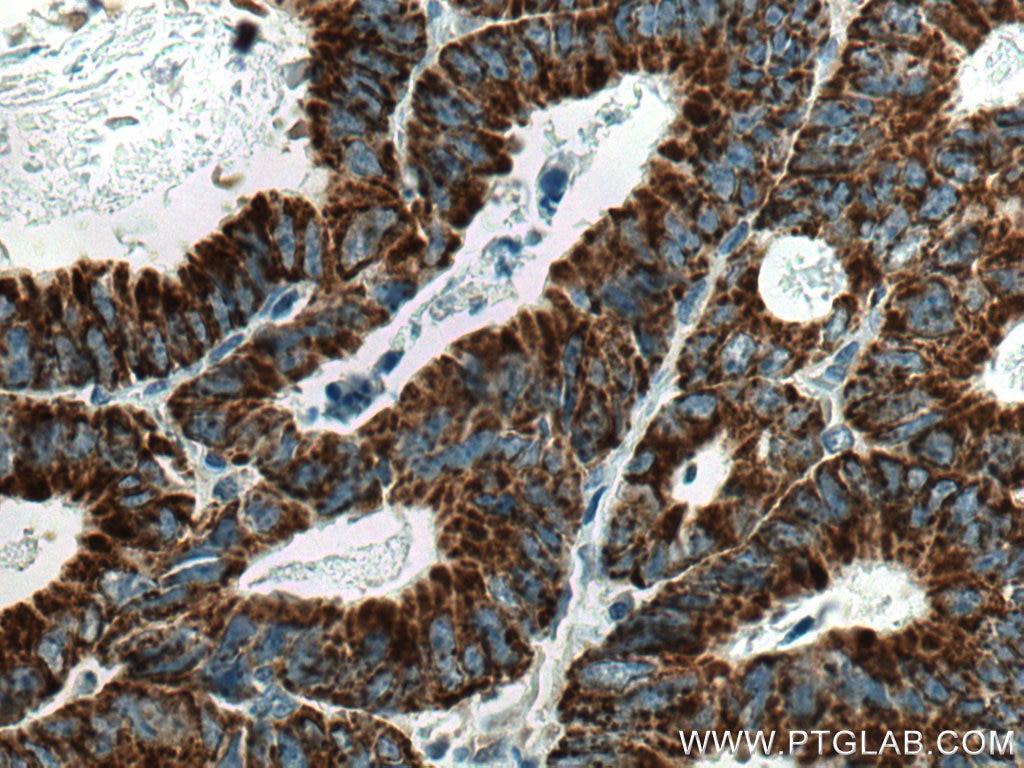 Immunohistochemistry (IHC) staining of human colon cancer tissue using CNOT4 Monoclonal antibody (67798-1-Ig)