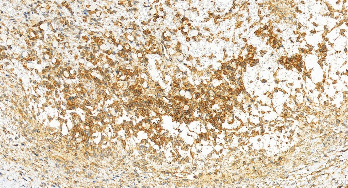 Immunohistochemistry (IHC) staining of human ovary cancer tissue using CNOT4 Recombinant antibody (83615-4-RR)
