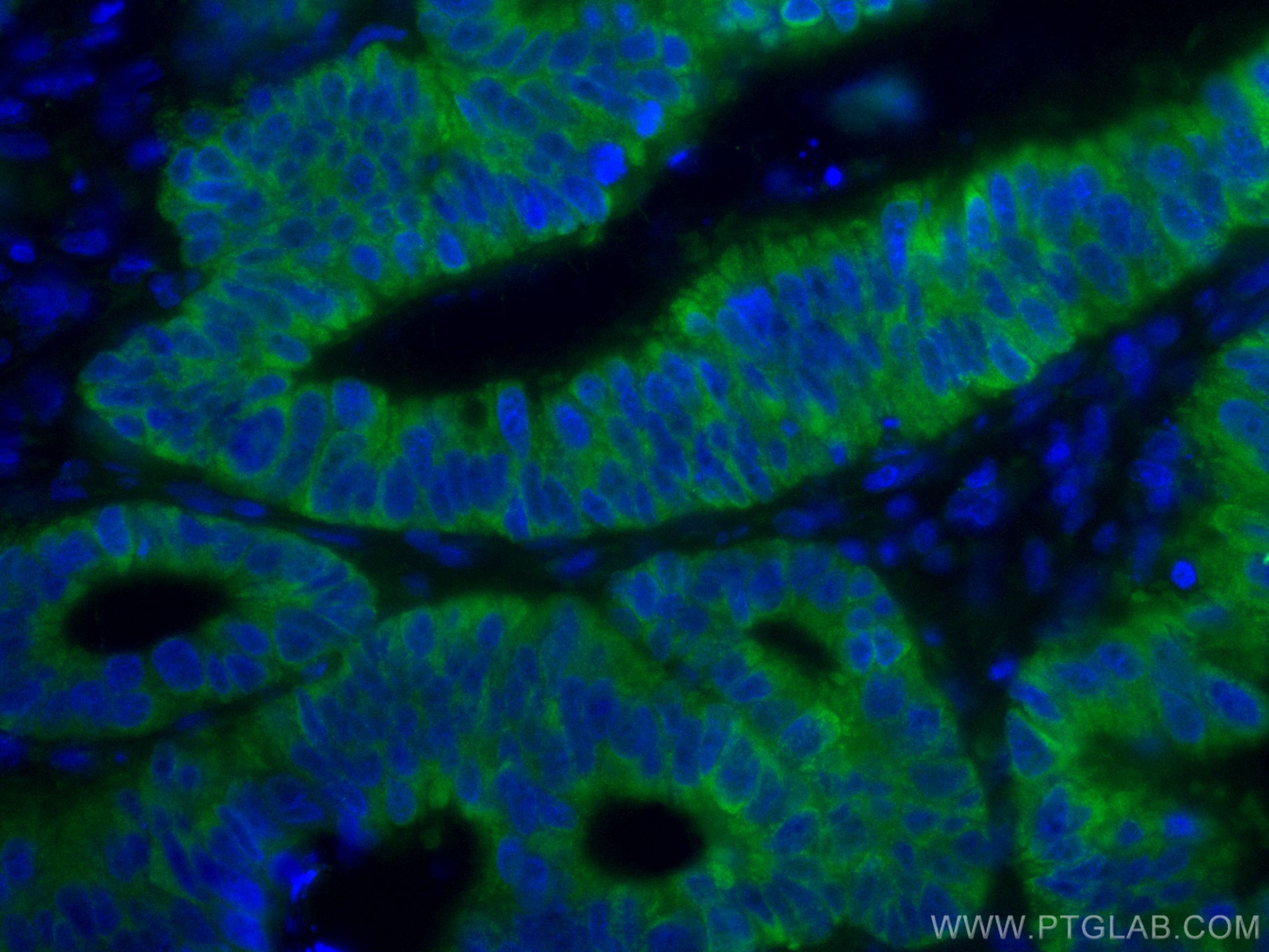 Immunofluorescence (IF) / fluorescent staining of human colon cancer tissue using CoraLite® Plus 488-conjugated CNOT4 Monoclonal ant (CL488-67798)