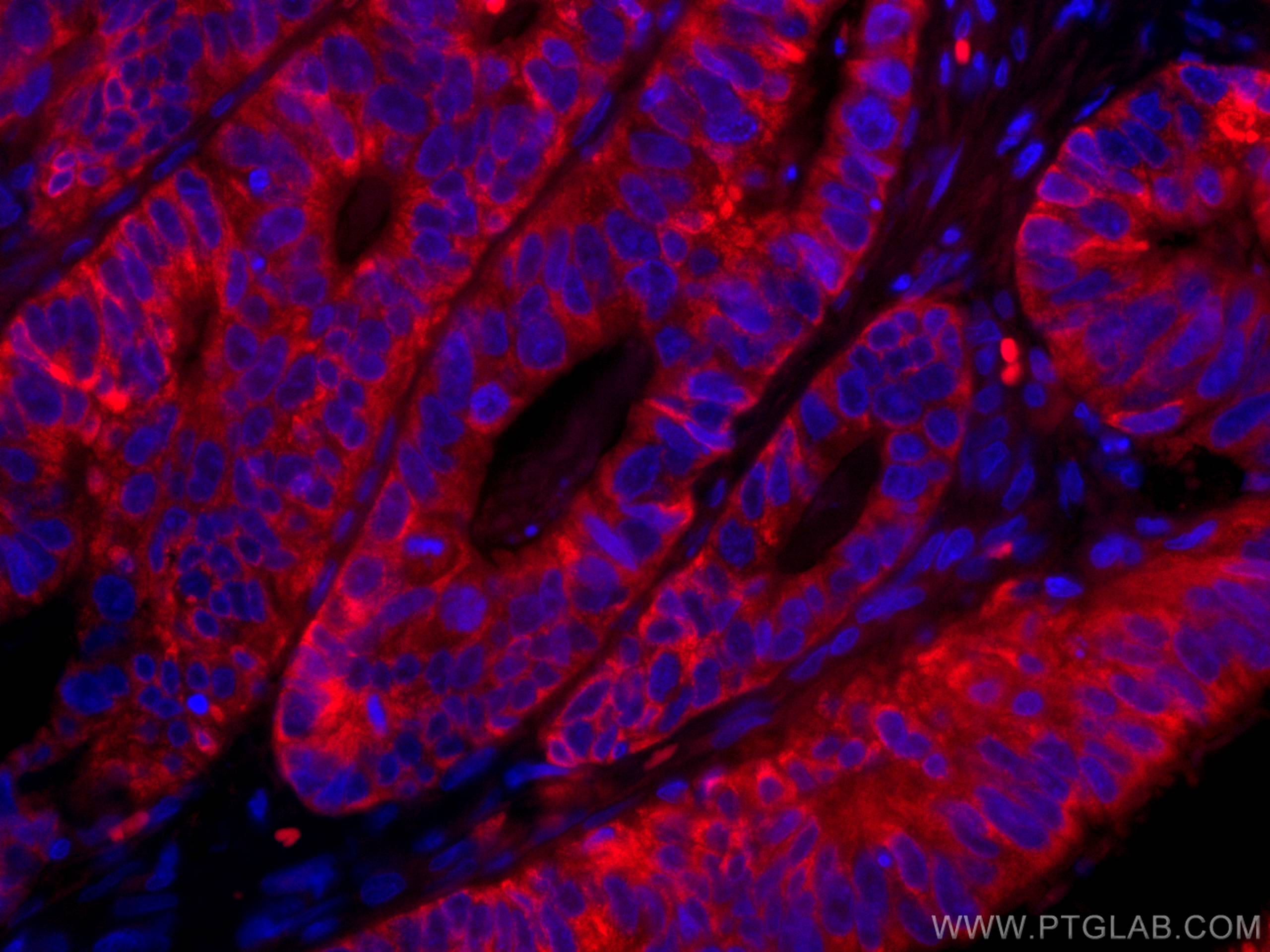 Immunofluorescence (IF) / fluorescent staining of human colon cancer tissue using CoraLite®594-conjugated CNOT4 Monoclonal antibody (CL594-67798)