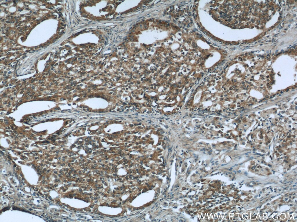 Immunohistochemistry (IHC) staining of human prostate cancer tissue using CNOT8 Polyclonal antibody (10752-1-AP)