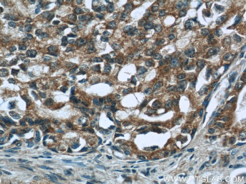 Immunohistochemistry (IHC) staining of human prostate cancer tissue using CNOT8 Polyclonal antibody (10752-1-AP)