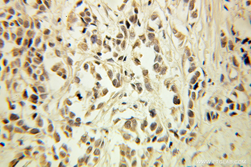 Immunohistochemistry (IHC) staining of human prostate cancer tissue using CNOT8 Polyclonal antibody (10752-1-AP)