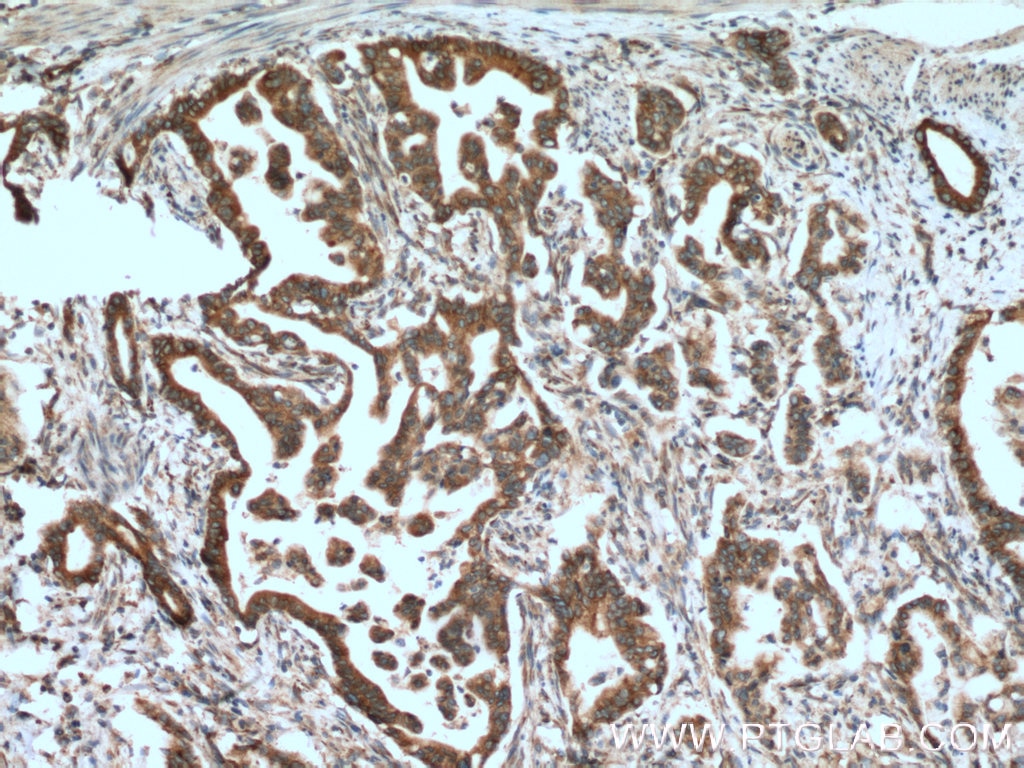 Immunohistochemistry (IHC) staining of human pancreas cancer tissue using CNPY2, MSAP Monoclonal antibody (66173-1-Ig)