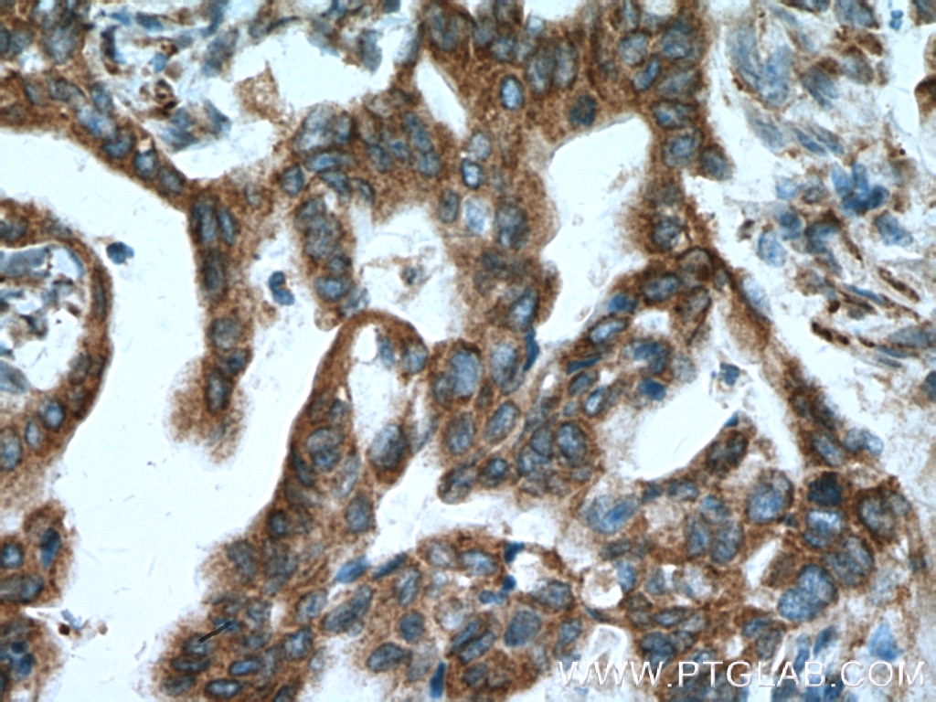 Immunohistochemistry (IHC) staining of human pancreas cancer tissue using CNPY2, MSAP Monoclonal antibody (66173-1-Ig)