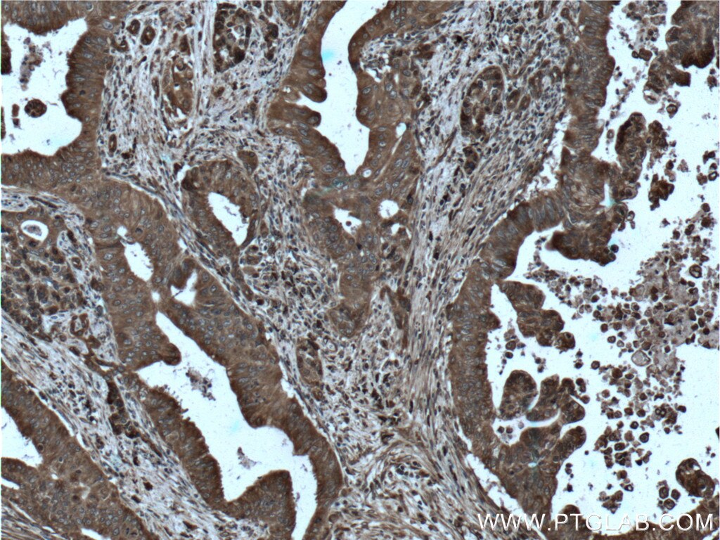 Immunohistochemistry (IHC) staining of human pancreas cancer tissue using CNPY2, MSAP Polyclonal antibody (14635-1-AP)