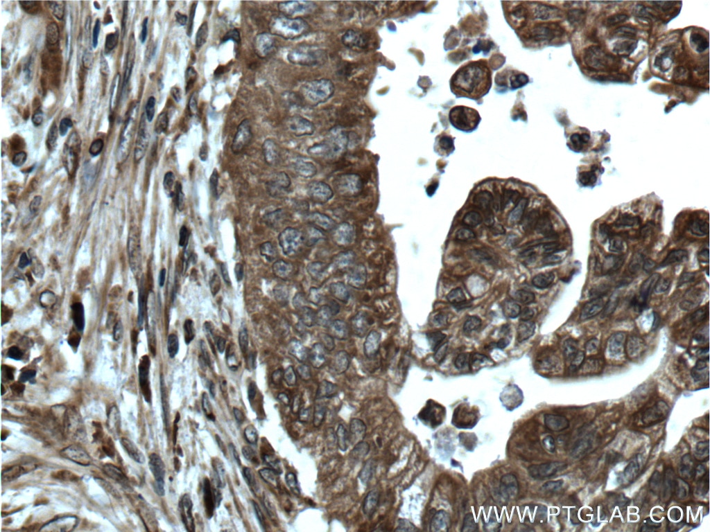 Immunohistochemistry (IHC) staining of human pancreas cancer tissue using CNPY2, MSAP Polyclonal antibody (14635-1-AP)
