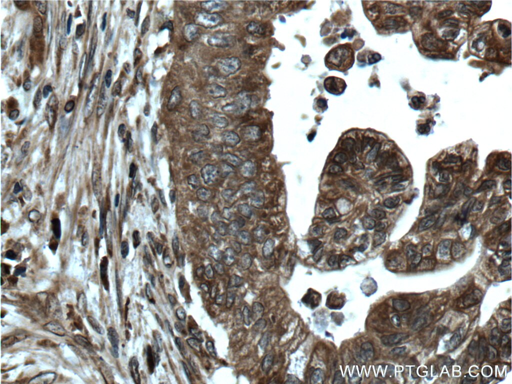 IHC staining of human pancreas cancer using 14635-1-AP