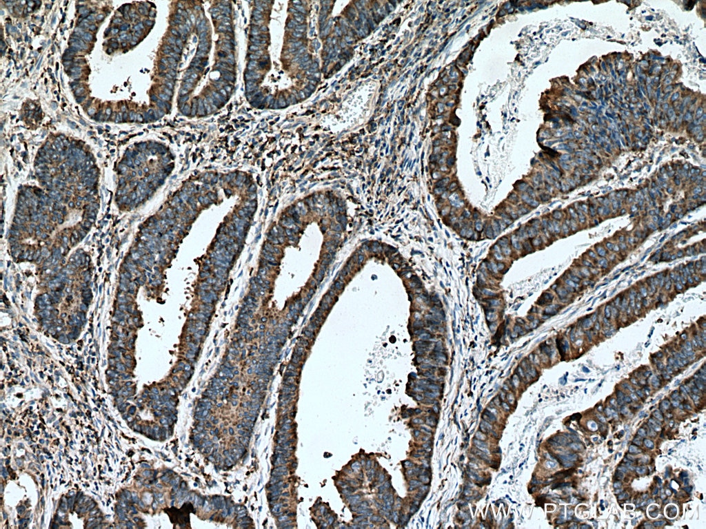 Immunohistochemistry (IHC) staining of human colon cancer tissue using CNPY3 Polyclonal antibody (15215-1-AP)