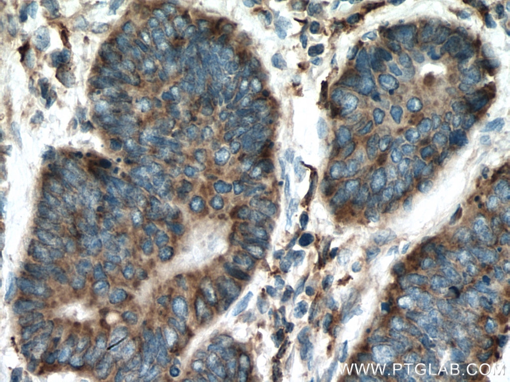 Immunohistochemistry (IHC) staining of human colon cancer tissue using CNPY3 Polyclonal antibody (15215-1-AP)