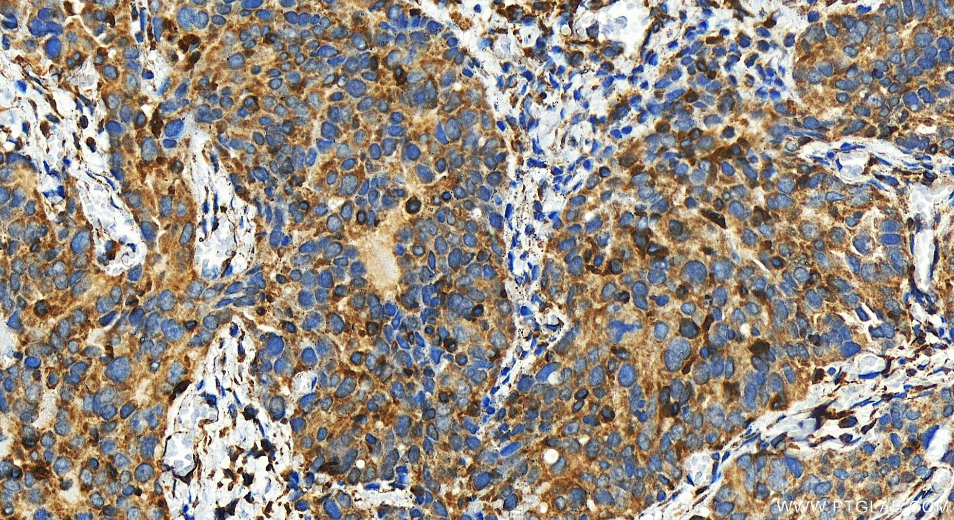 Immunohistochemistry (IHC) staining of human ovary cancer tissue using COA4 Polyclonal antibody (30721-1-AP)