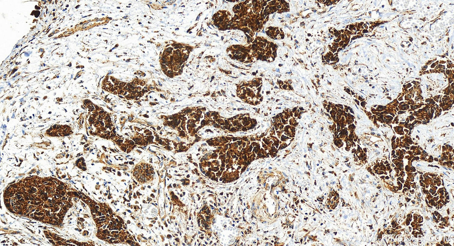 Immunohistochemistry (IHC) staining of human intrahepatic cholangiocarcinoma tissue using COA4 Recombinant antibody (83326-1-RR)
