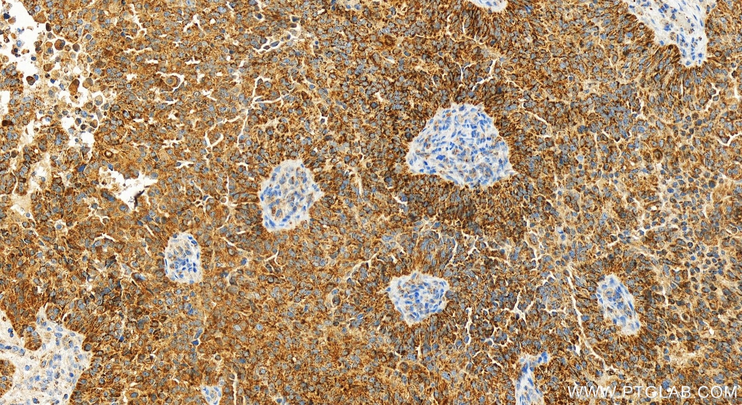 Immunohistochemistry (IHC) staining of human ovarian  cancer using COA4 Recombinant antibody (83326-1-RR)