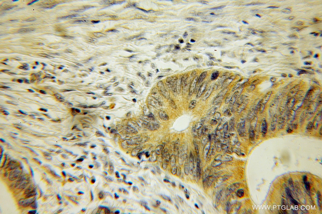 Immunohistochemistry (IHC) staining of human colon cancer tissue using COASY Polyclonal antibody (12991-1-AP)