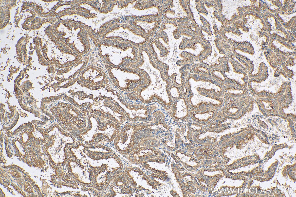 Immunohistochemistry (IHC) staining of human ovary tumor tissue using COG1 Polyclonal antibody (10767-1-AP)
