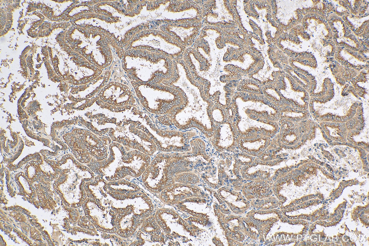 Immunohistochemistry (IHC) staining of human ovary tumor tissue using COG1 Polyclonal antibody (10767-1-AP)