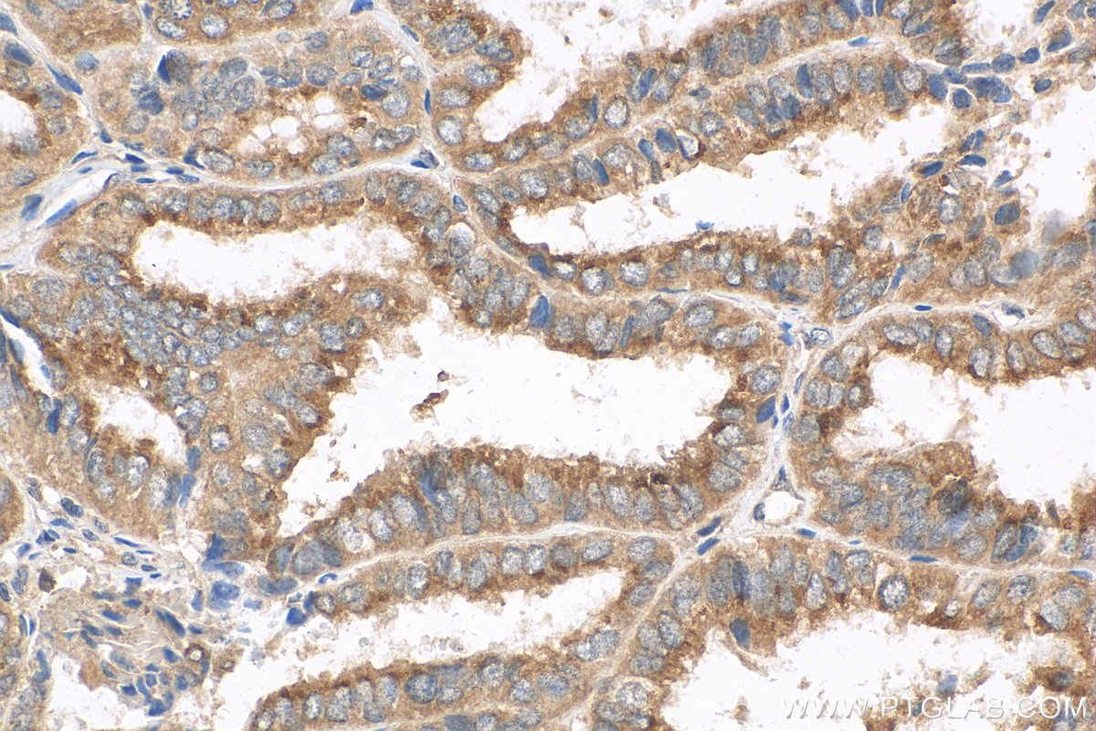 Immunohistochemistry (IHC) staining of human ovary tumor tissue using COG1 Polyclonal antibody (10767-1-AP)