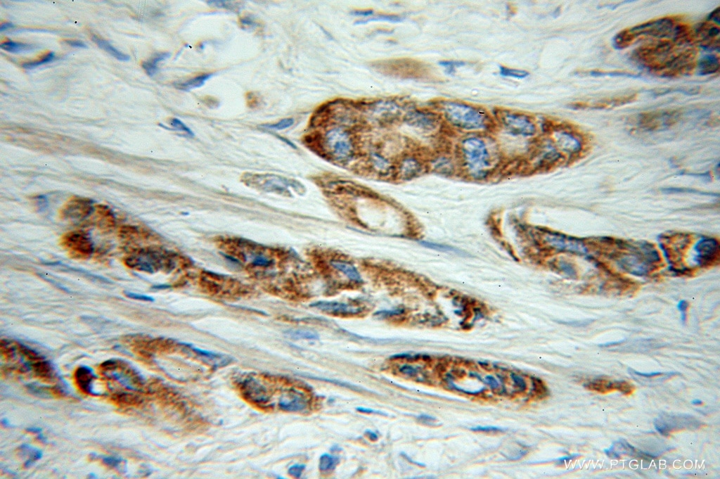 Immunohistochemistry (IHC) staining of human prostate cancer tissue using COG3 Polyclonal antibody (11130-1-AP)