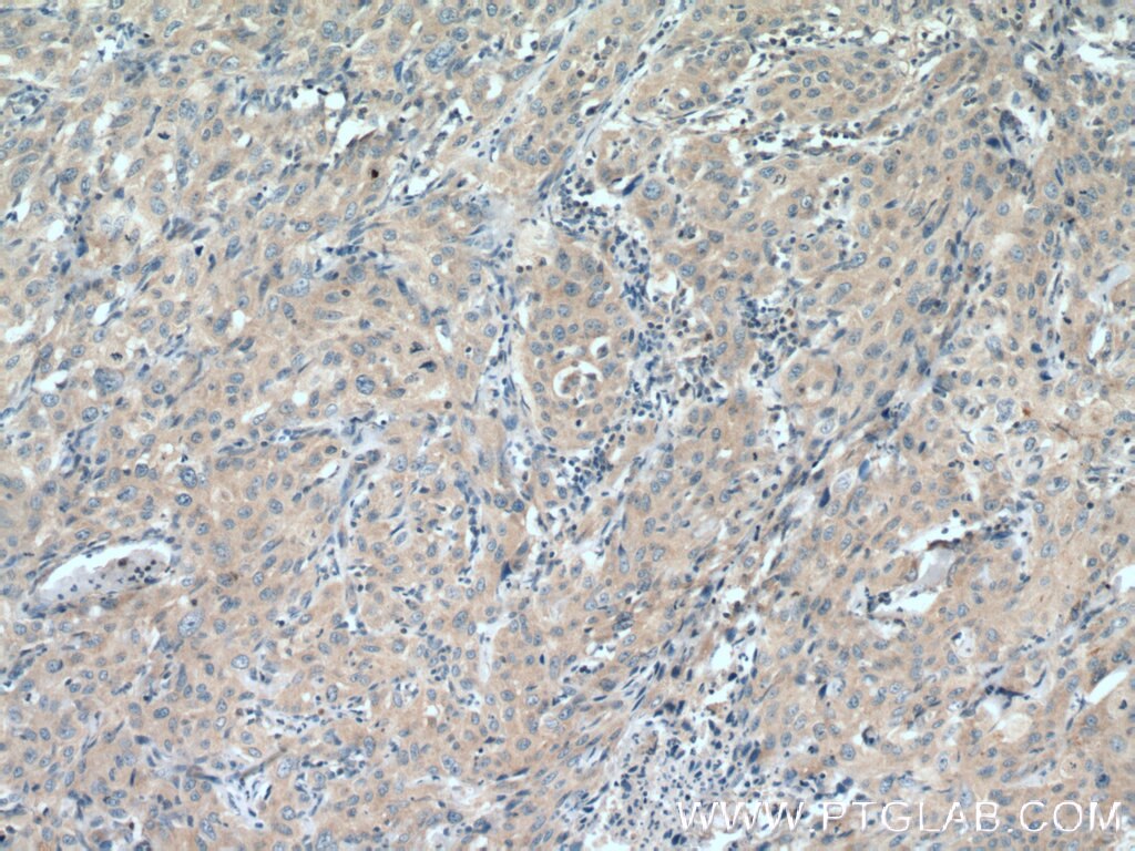 Immunohistochemistry (IHC) staining of human cervical cancer tissue using COG7 Polyclonal antibody (13552-1-AP)