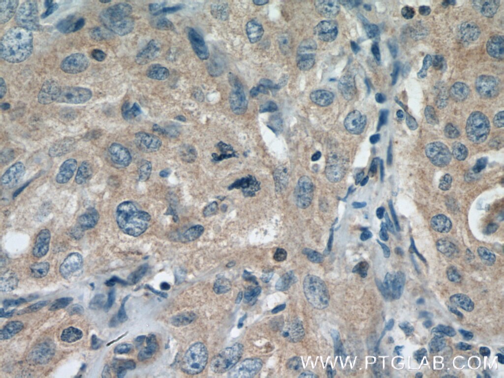 Immunohistochemistry (IHC) staining of human cervical cancer tissue using COG7 Polyclonal antibody (13552-1-AP)