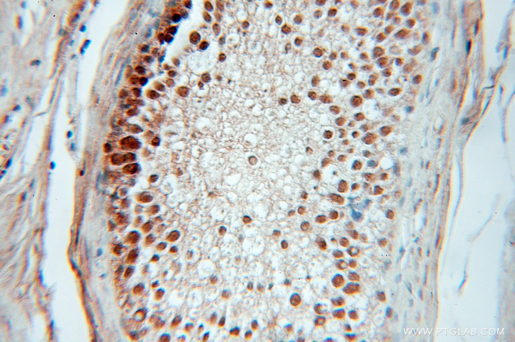 Immunohistochemistry (IHC) staining of human prostate cancer tissue using Coilin Polyclonal antibody (10967-1-AP)