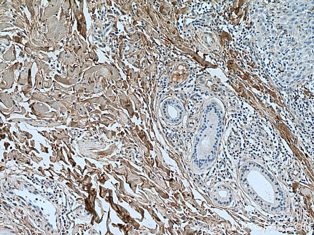 Immunohistochemistry (IHC) staining of human skin cancer tissue using Collagen Type I Polyclonal antibody (14695-1-AP)