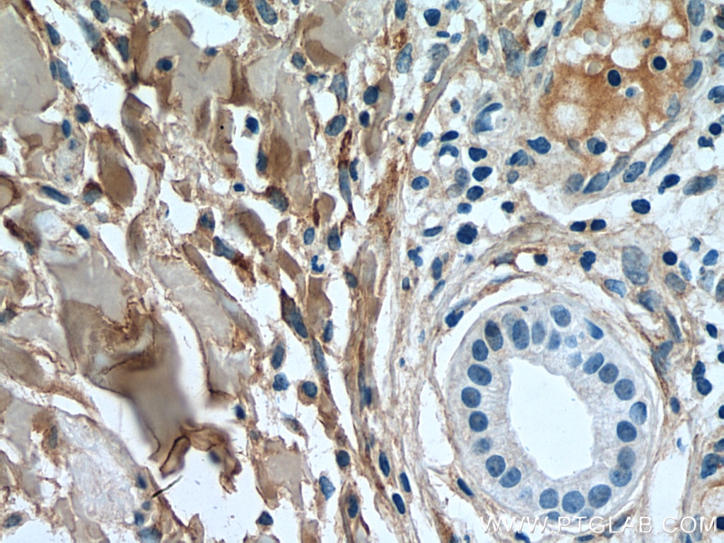 Immunohistochemistry (IHC) staining of human skin cancer tissue using Collagen Type I Polyclonal antibody (14695-1-AP)
