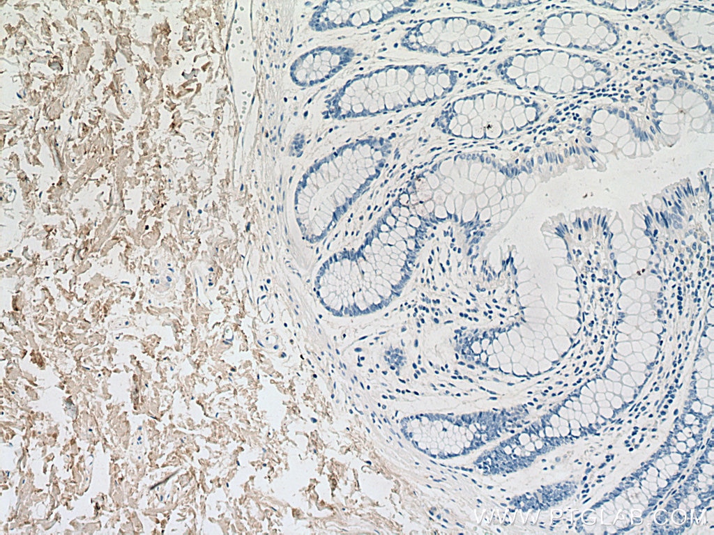 Immunohistochemistry (IHC) staining of human colon tissue using Collagen Type I Polyclonal antibody (14695-1-AP)