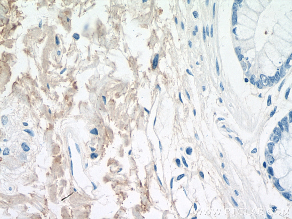 Immunohistochemistry (IHC) staining of human colon tissue using Collagen Type I Polyclonal antibody (14695-1-AP)