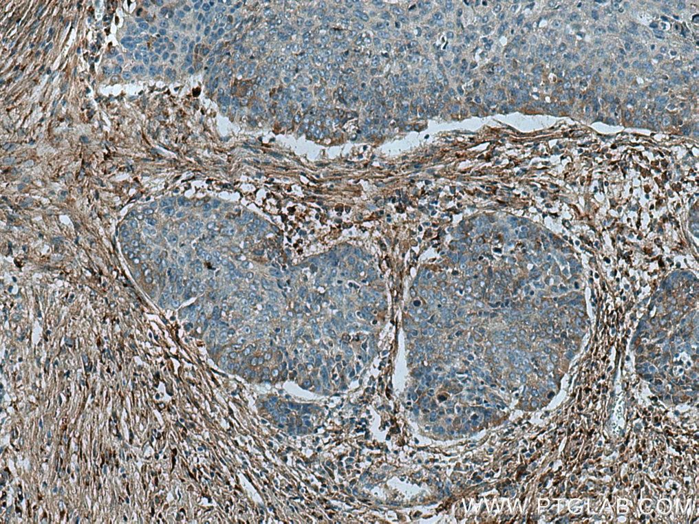 Immunohistochemistry (IHC) staining of human oesophagus cancer tissue using Collagen Type I Polyclonal antibody (14695-1-AP)