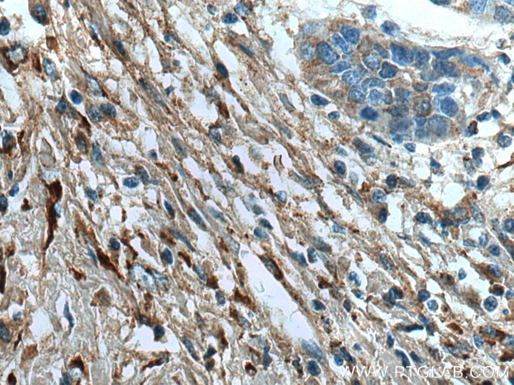 IHC staining of human oesophagus cancer using 14695-1-AP