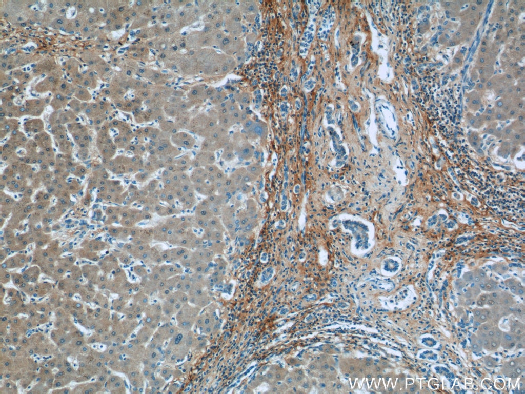 Immunohistochemistry (IHC) staining of human hepatocirrhosis tissue using Collagen Type III (C-terminal) Polyclonal antibody (13548-1-AP)