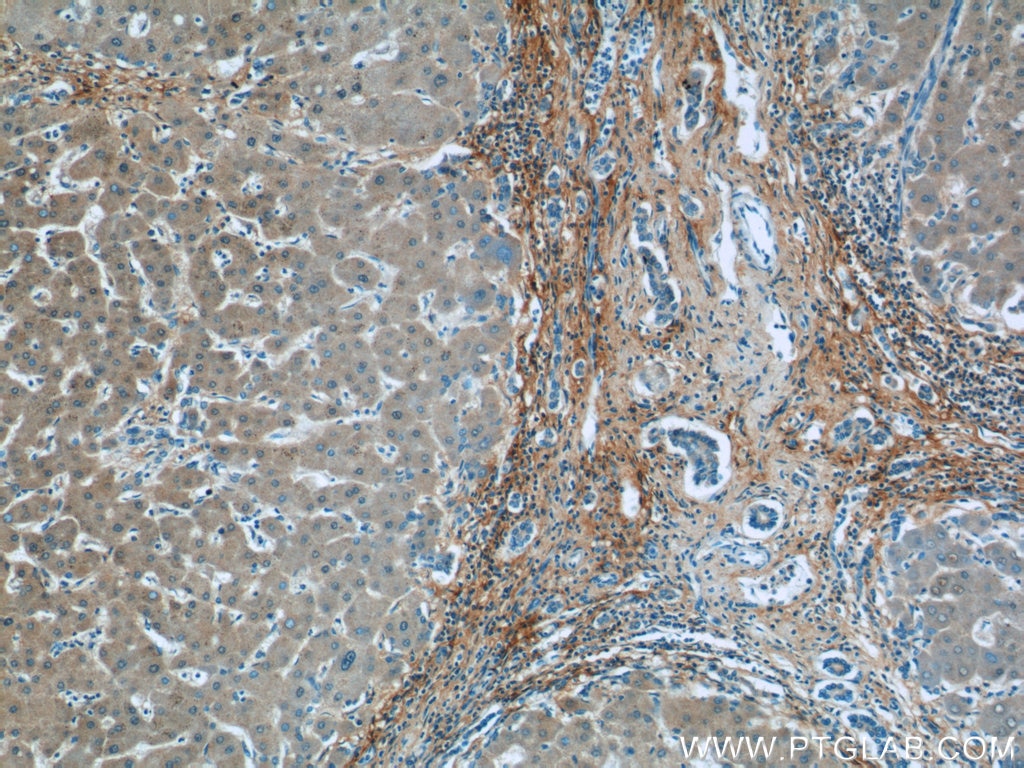 IHC staining of human hepatocirrhosis using 13548-1-AP