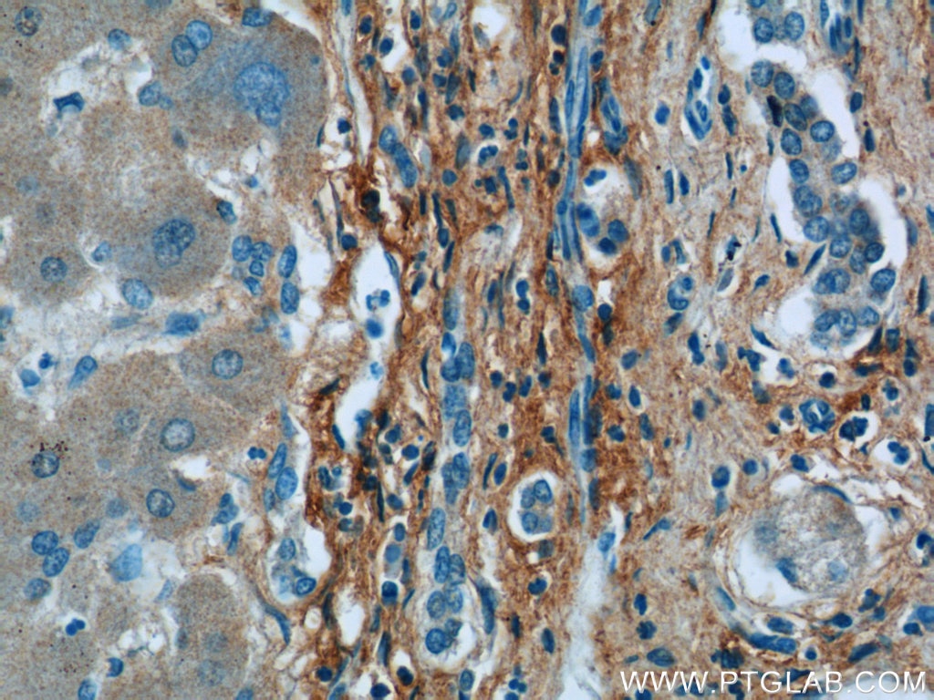 Immunohistochemistry (IHC) staining of human hepatocirrhosis tissue using Collagen Type III (C-terminal) Polyclonal antibody (13548-1-AP)