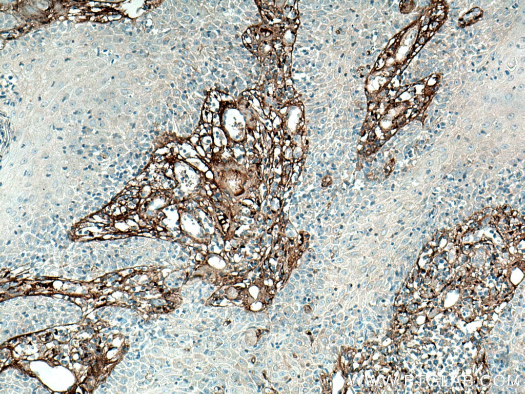 Immunohistochemistry (IHC) staining of human skin cancer tissue using Collagen Type III (N-terminal) Polyclonal antibody (22734-1-AP)