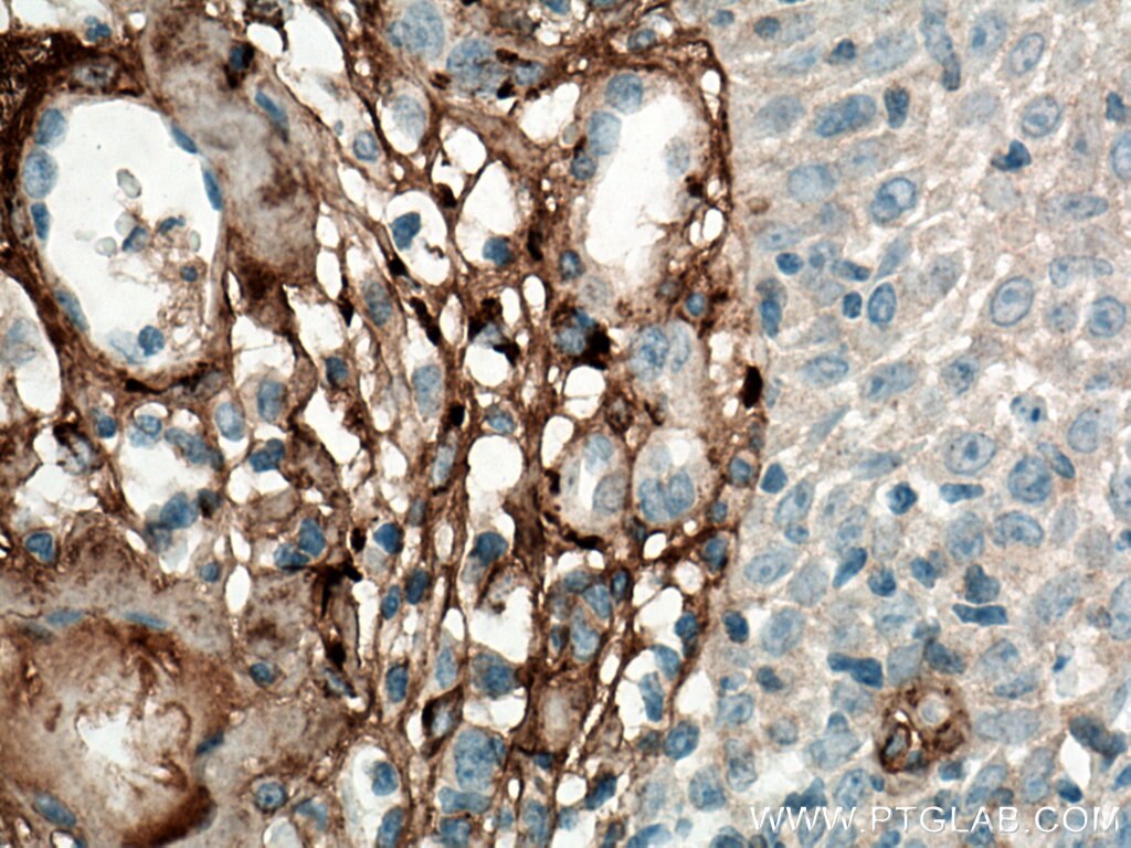 Immunohistochemistry (IHC) staining of human skin cancer tissue using Collagen Type III (N-terminal) Polyclonal antibody (22734-1-AP)