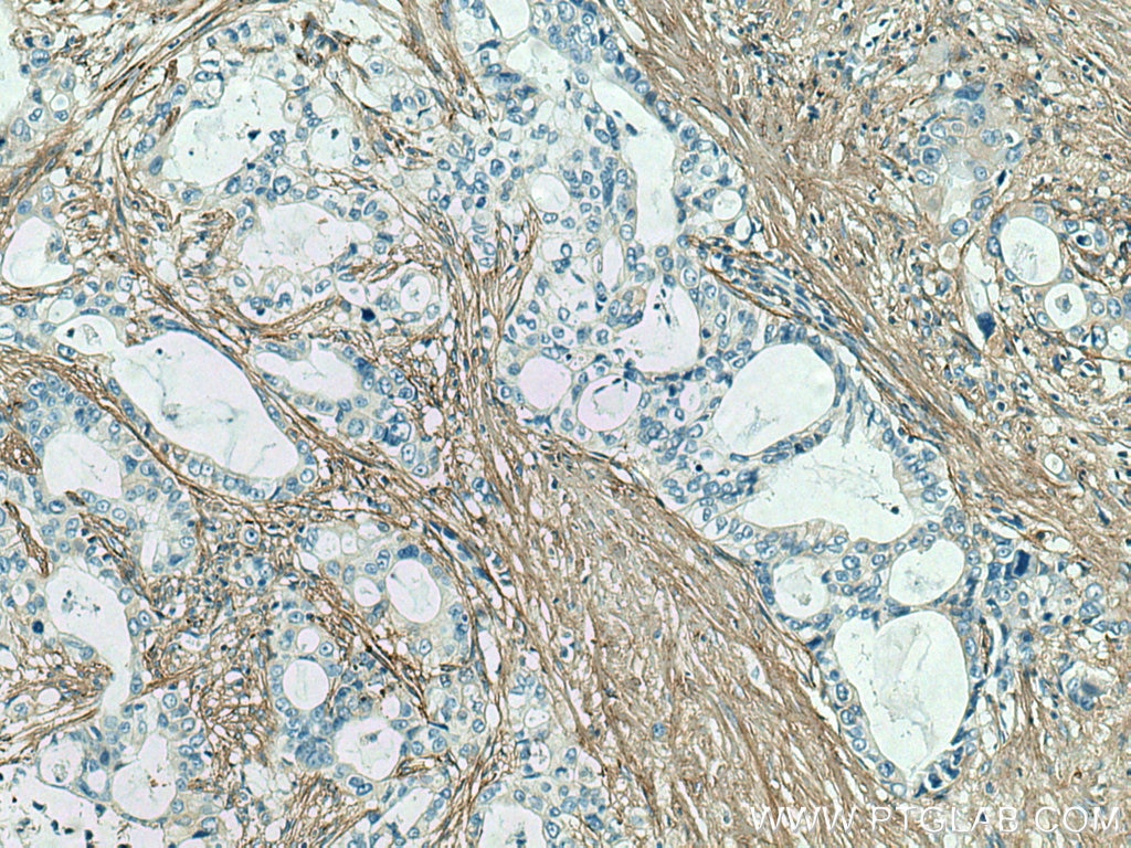 Immunohistochemistry (IHC) staining of human pancreas cancer tissue using Collagen Type III (N-terminal) Polyclonal antibody (22734-1-AP)