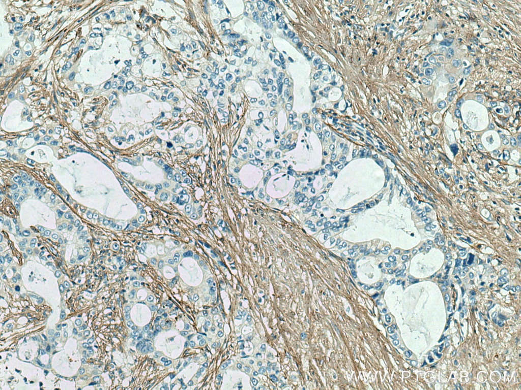 IHC staining of human pancreas cancer using 22734-1-AP