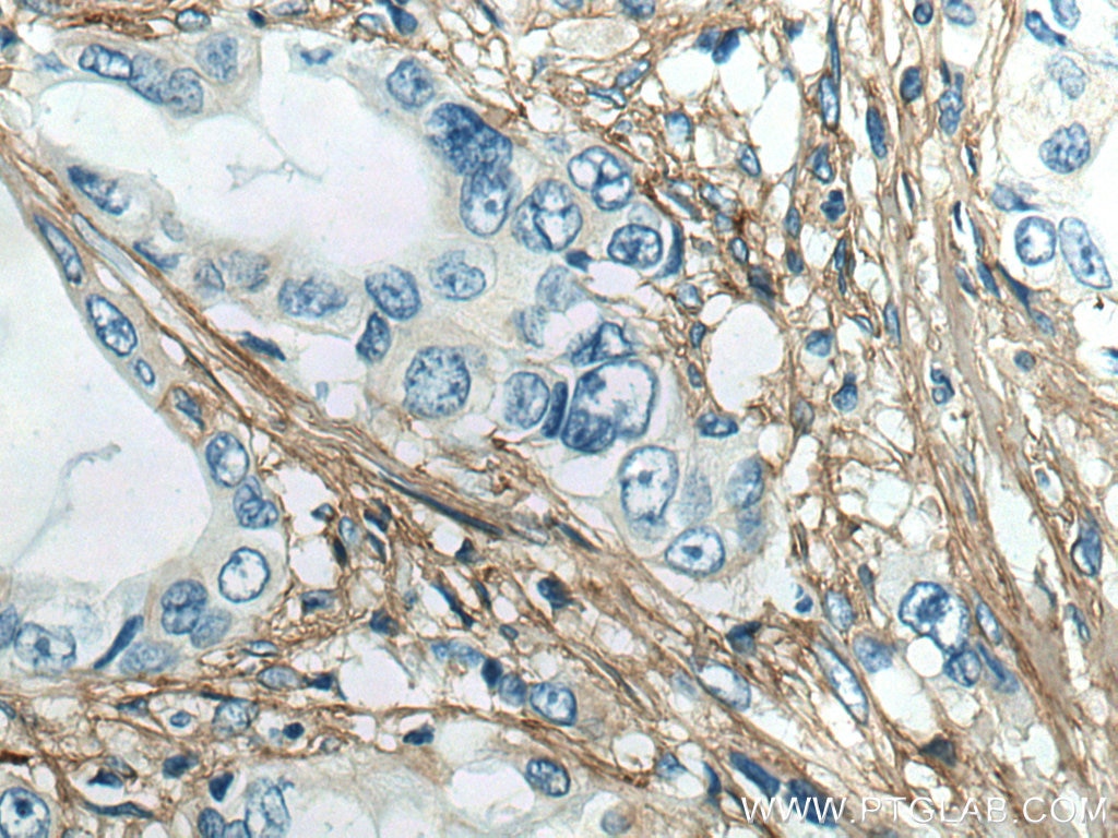 IHC staining of human pancreas cancer using 22734-1-AP