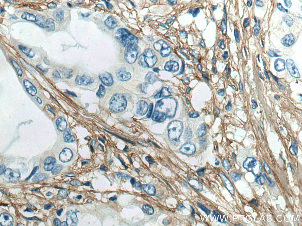 Immunohistochemistry (IHC) staining of human pancreas cancer tissue using Collagen Type III (N-terminal) Polyclonal antibody (22734-1-AP)