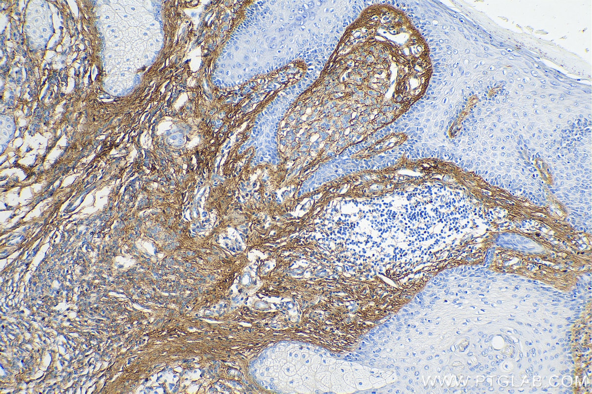 Immunohistochemistry (IHC) staining of human malignant melanoma tissue using Collagen Type III (N-terminal) Polyclonal antibody (22734-1-AP)