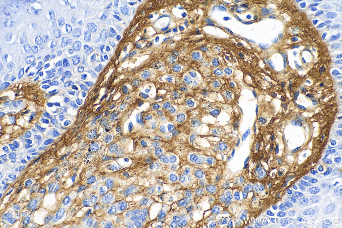 Immunohistochemistry (IHC) staining of human malignant melanoma tissue using Collagen Type III (N-terminal) Polyclonal antibody (22734-1-AP)