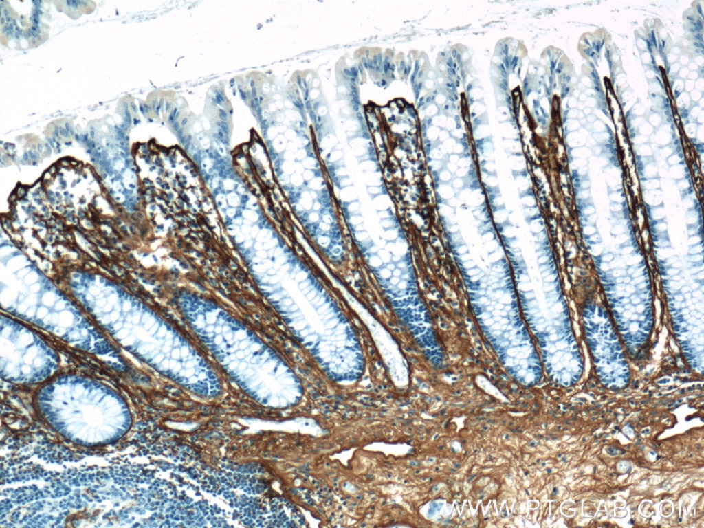 Immunohistochemistry (IHC) staining of human colon tissue using Collagen Type III (N-terminal) Polyclonal antibody (22734-1-AP)