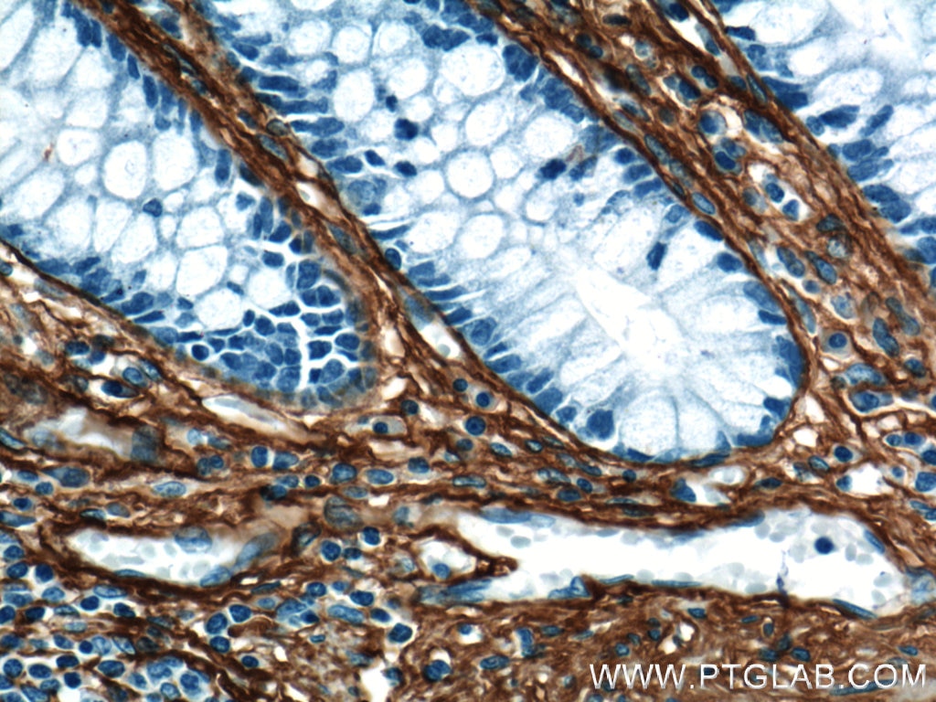 Immunohistochemistry (IHC) staining of human colon tissue using Collagen Type III (N-terminal) Polyclonal antibody (22734-1-AP)