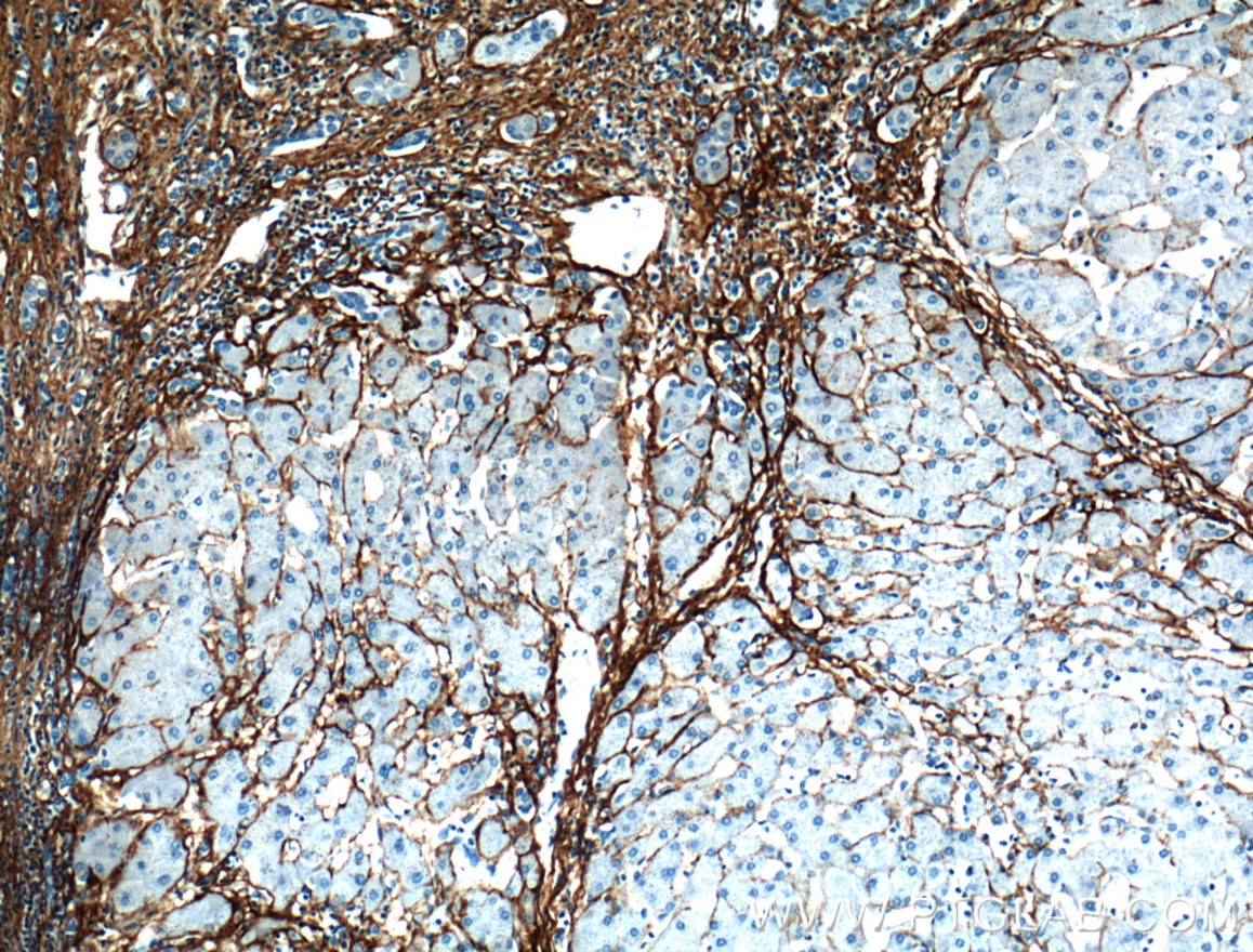 Immunohistochemistry (IHC) staining of human hepatocirrhosis tissue using Collagen Type III (N-terminal) Polyclonal antibody (22734-1-AP)