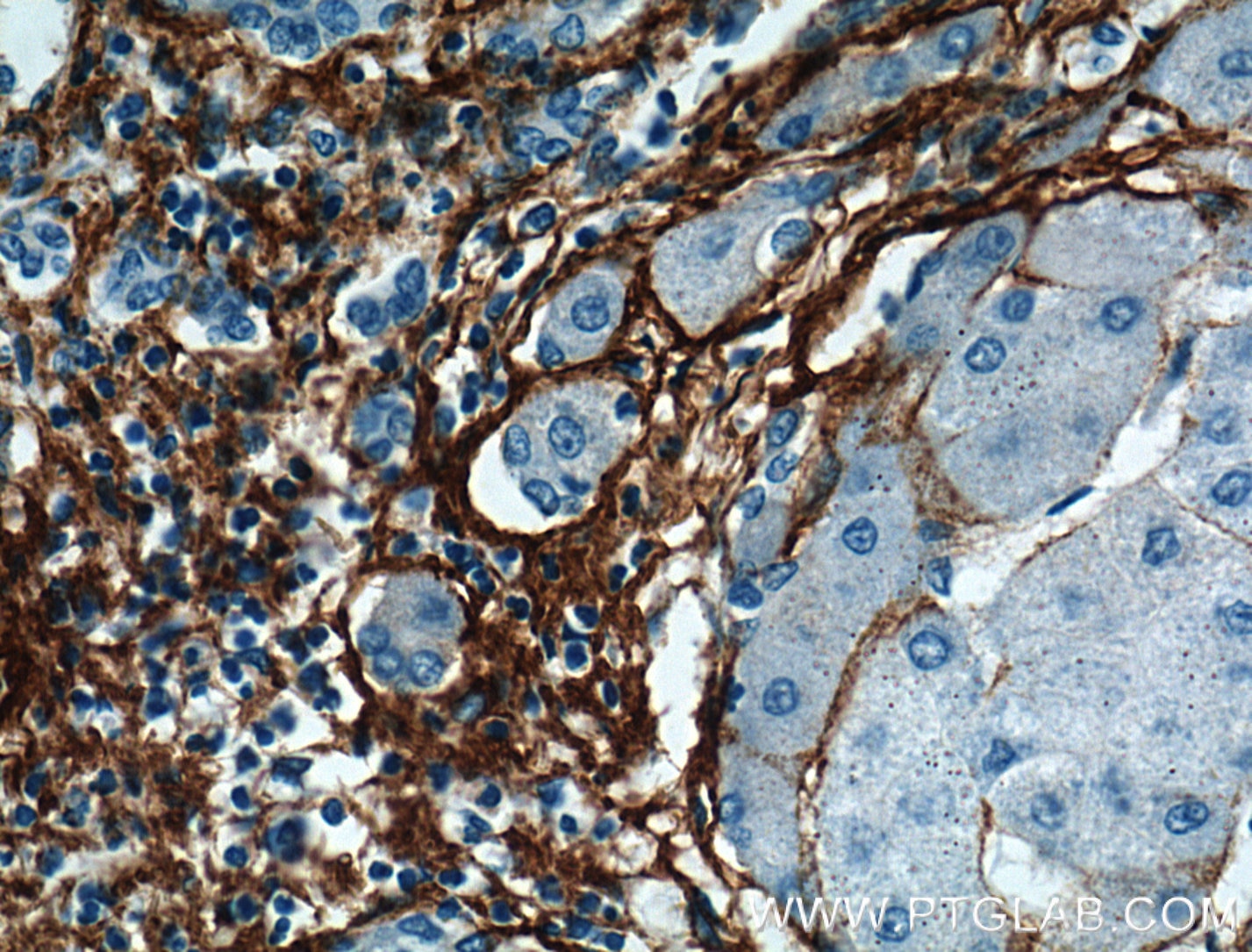 Immunohistochemistry (IHC) staining of human hepatocirrhosis tissue using Collagen Type III (N-terminal) Polyclonal antibody (22734-1-AP)