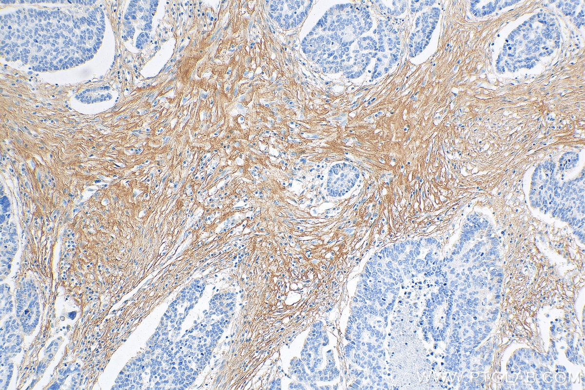 Immunohistochemistry (IHC) staining of human ovary tumor tissue using COL3A1 Monoclonal antibody (68320-1-Ig)