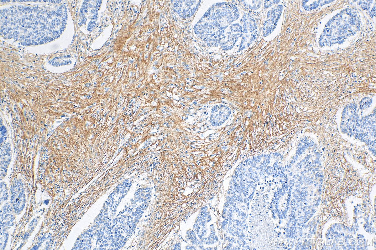 IHC staining of human ovary tumor using 68320-1-Ig